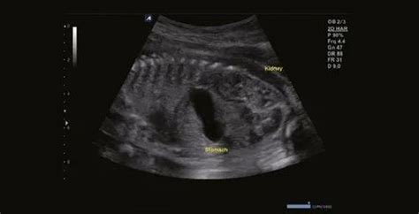 Ultrasound Machine - BPL E-CUBE 12 Platinum Ultrasound Machine ...