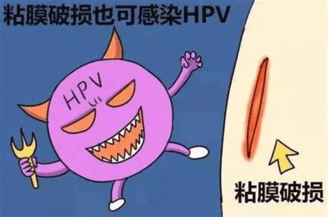 宫颈切除后还会感染hpv吗_中华康网