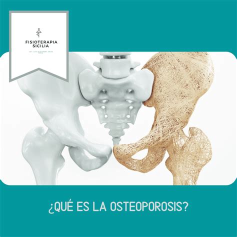 ¿Qué es la Osteoporosis? – Fisioterapia Sicilia