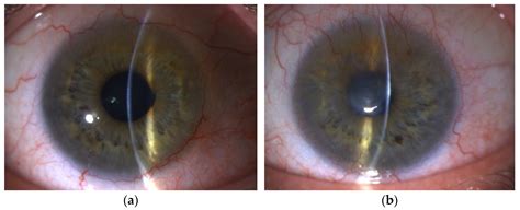 Diagnostic Algorithm for Surgical Management of Limbal Stem Cell Deficiency