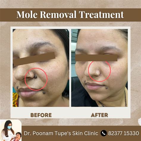Best Skin Specialist in Keshav Nagar Mundhwa | Dr. Poonam Tupe Bandal ...