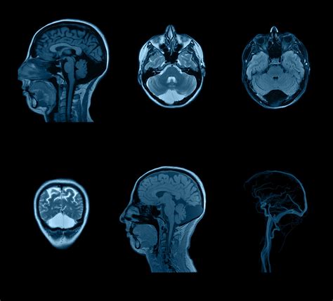 Brain Lesions – Symptoms, Causes, Types and Treatment - Apollo Hospitals