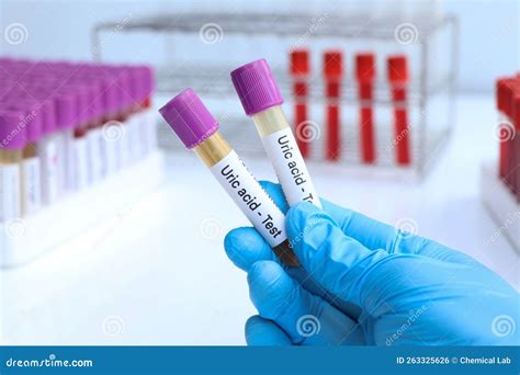 What Color Tube Is Used For Uric Acid Test at Donna Champion blog
