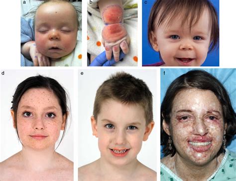 Xeroderma pigmentosum causes, signs, symptoms, diagnosis & treatment