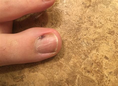 Melanoma under toenail pictures: black spot, nail melanoma pictures, toenail melanoma pictures ...