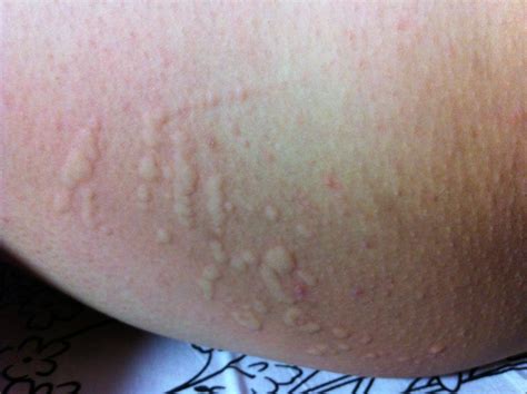 有人能看出这是什么症状么？腿根部起的像蚊子咬了一样，非常的痒_百度知道