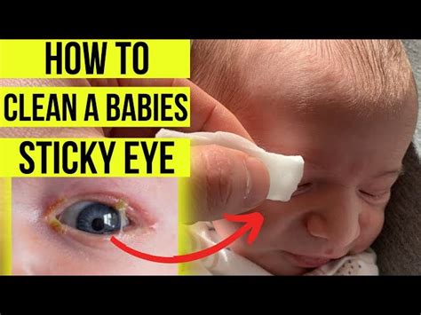 Unveiling Infant Yellow Eye Discharge: Discoveries That Illuminate the ...