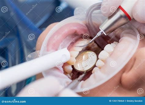 Closeup of Modern Professional Teeth Cleaning in Dentistry with Specialized Equipment. Stock ...