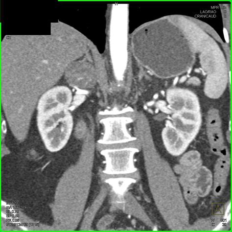 Adrenal Adenoma - Adrenal Radiology Case Studies - CTisus CT Scanning