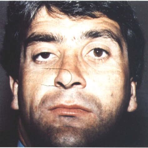 Image result for Levator Resection Surgery