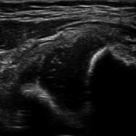 How to Perform Hip Ultrasound 的图像结果