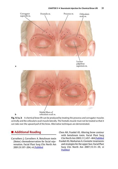 Image result for Botox Injection Patterns