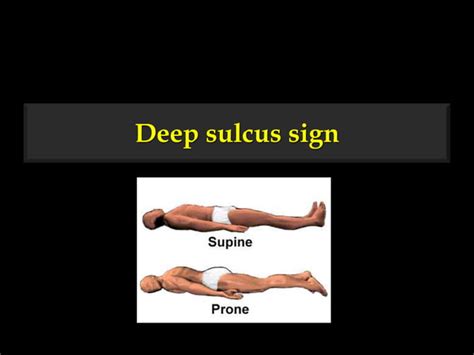 Sulcus Sign Explained 的图像结果