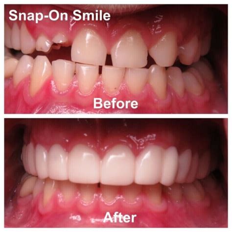 Veneers Teeth Snap On Smile Dentures Temporary Teeth India | Ubuy
