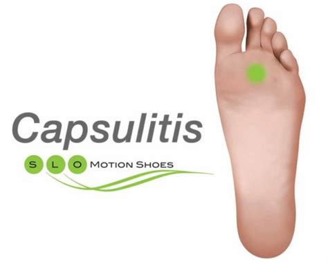 Capsulitis - SLO Motion ShoesSLO Motion Shoes