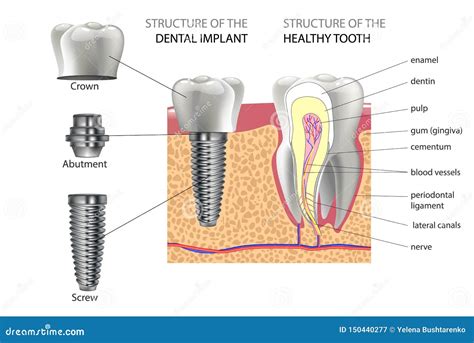 Dental Implant Parts