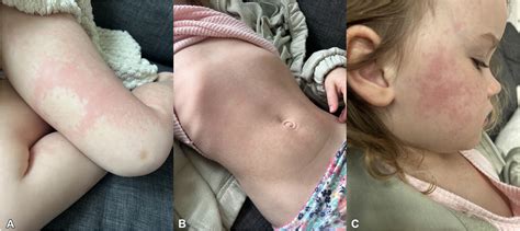 Serum Sickness Like Reaction