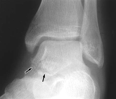 Talus Avulsion Fracture