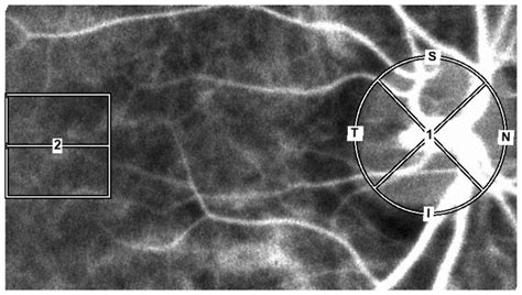 Investigation of Ocular Blood Flow in Males with Metabolic Syndrome[v1 ...