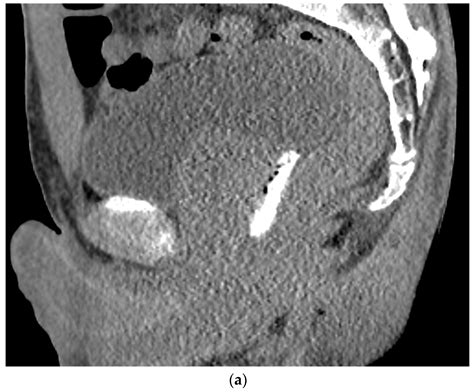 Hydrogel Spacer SpaceOAR Vue for Prostate Radiotherapy | Encyclopedia MDPI