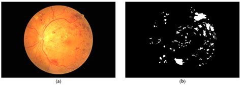 Programmatically Localizing Diabetic Retinopathy Features in 45-Degree ...