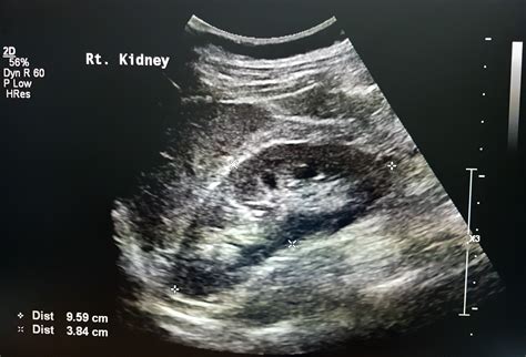 Crushing Kidney Stones With Ultrasound at Chloe Snider blog