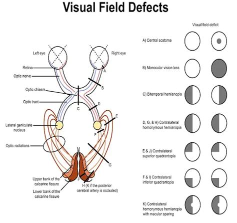 Image result for Visual Pathway Defects