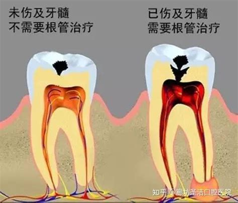 牙髓炎的症状和原因是什么？ - 知乎