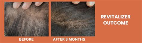 Buy Ivachi Hair Follicle Revitalizer | Hair Growth Serum for Men ...