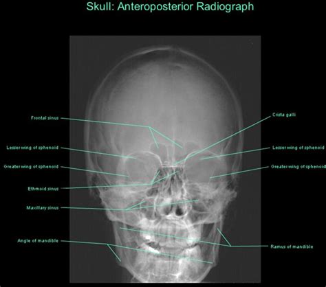 Frontal radiograph of skull | Anatomy images, Medical radiography ...