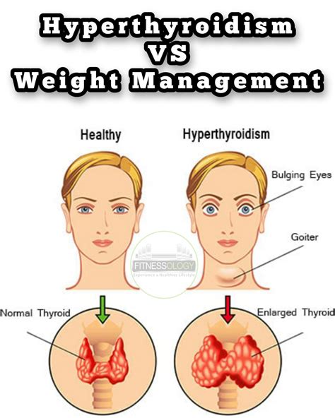 Thyroid Weight Gain