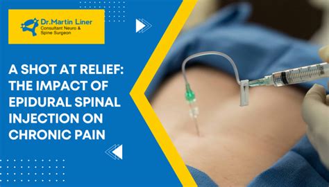 Image result for Epidural Injection