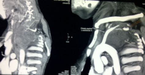 Neurofibroma removal | Pediatric Laparoscopy