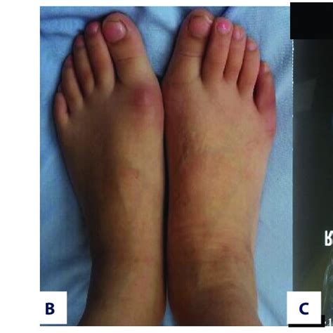 (PDF) Reverse-Shoe Wearing Method for Treating Toe-In Gait in Children ...