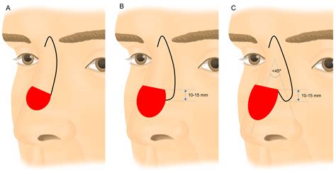 Nasal Dorsum Rotation–Transposition Flap Associated with Guitar-String ...