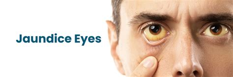 Jaundice Eyes: Causes, Symptoms, and Treatments