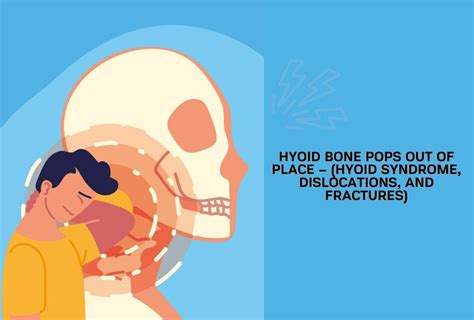 Hyoid Bone Pops Out of Place – (Hyoid Syndrome, Dislocations, and ...