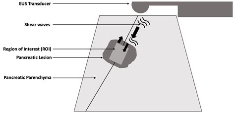The Role of Endoscopic Ultrasound-Guided Shear Wave Elastography in ...