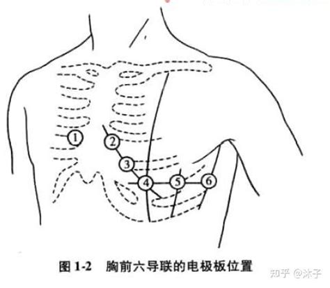 十八导联心电图的重要临床意义__中国医疗