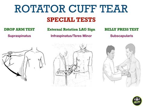 Dr. Abdul Rehman Patel | ️Rotator Cuff Tear ️ Special Tests . 1️⃣Drop Arm Test - The patient is ...