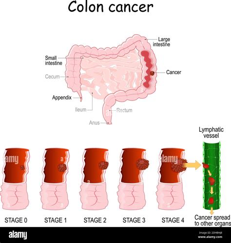 Image result for Appendix Cancer Symptoms