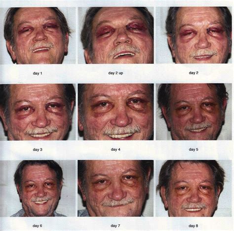 Upper Blepharoplasty Healing Process - Woolfson Eye Institute