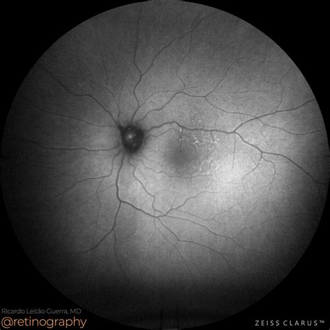 Optic disc drusen and Soft drusen – Retinography
