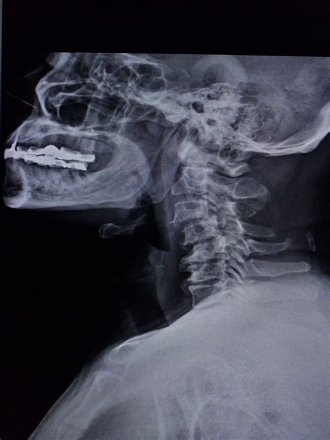 Retrolisthesis C3 C4