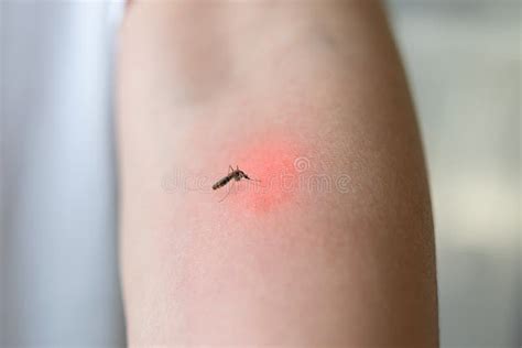 叮咬蚊子 库存图片. 图片 包括有 叮咬蚊子 - 930553