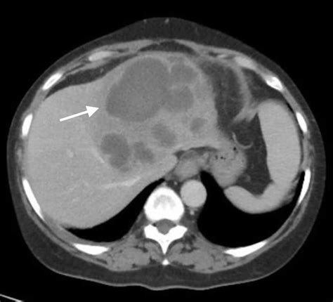 Liver abscess, causes, signs, symptoms, diagnosis, treatment & prognosis