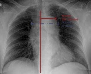 En radiografía de tórax, ¿a partir de qué medida se considera ...