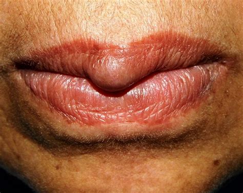 Kuvatulokset haulle blister on inner lip of mouth
