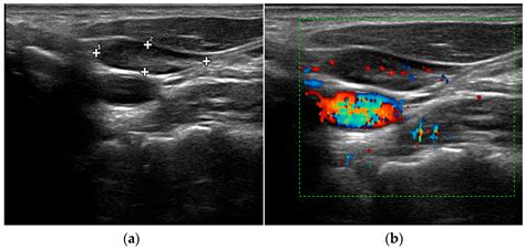 Parathyroid Ultrasound