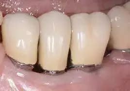 Periodontitis linked with reduced alveolar bone thickness and density
